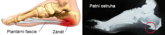 Plantarni fascitida patní ostruha